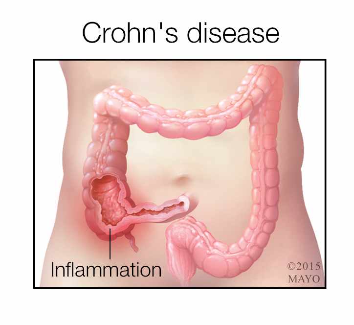 crohns-disease-nutrition-planet-weekly